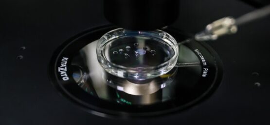 فریز و تعیین جنسیت جنین، راهکاری برای باروری هدفمند