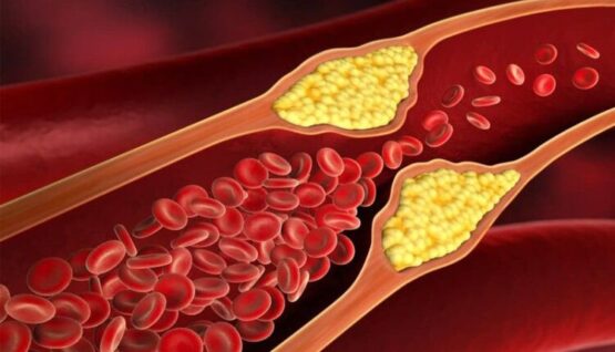 زنگ خطر افزایش کلسترول در جوانان